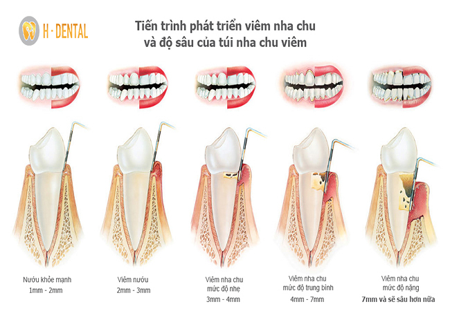 Quy trình trám răng chữa tủy tại nha khoa HDental