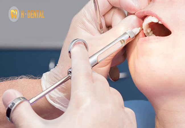 Gây tê vùng răng hư tủy giúp bệnh nhân thoải mái trong quá trình chữa tủy răng