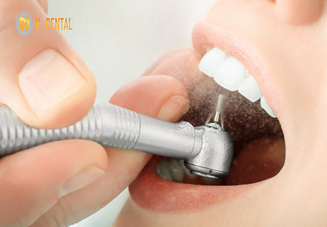 Trám răng thưa hiệu quả trong các tình trạng khuyết hỏng răng nhẹ
