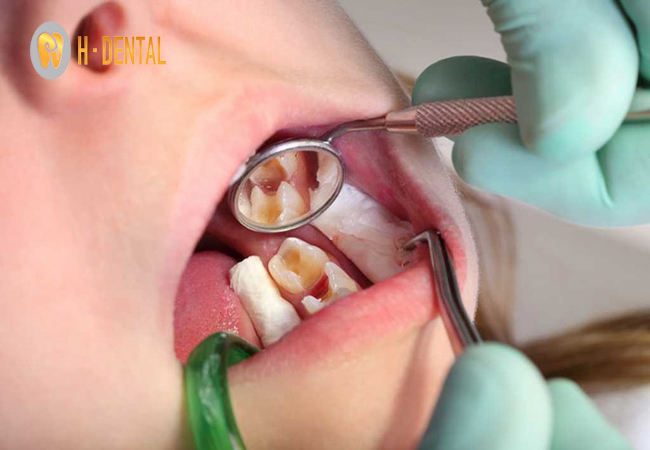 Phục hình ống tủy để giúp răng khỏe trở lại