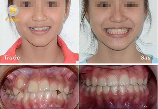 Cơ chế hoạt động của niềng răng vô hình tương tự với niềng răng mắc cài