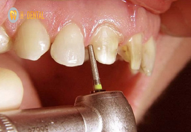 Để bọc răng sứ mài cùi răng là kỹ thuật bắt buộc thực hiện