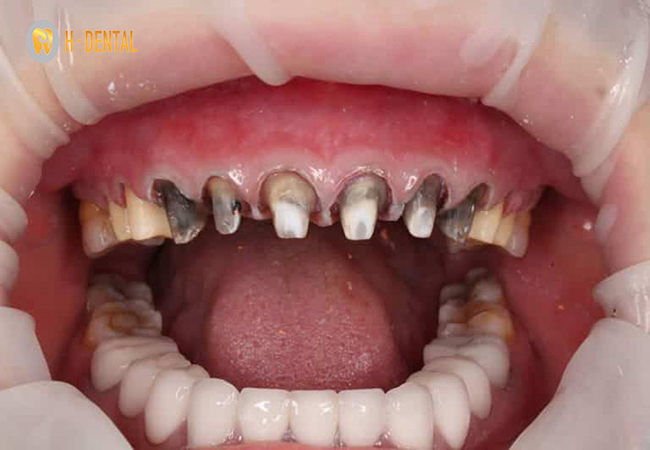 Nhược điểm khi bọc răng sứ là phải mài cùi răng thật