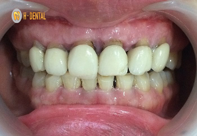 Tiêu chân răng là một biến chứng phổ biến mà bệnh nhân thường gặp phải