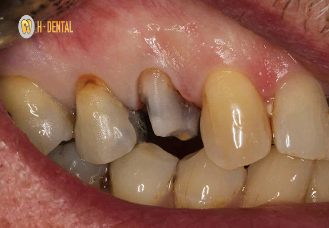 Nếu mắc bệnh lý thì cần điều trị dứt điểm trước khi tiến hành bọc sứ răng