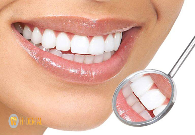 Trám răng thưa giúp thẩm mỹ hàm răng và bảo tồn răng thật